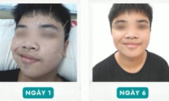 Nam sinh lớp 10 bất ngờ bị liệt nửa mặt vì bệnh “khẩu nhãn oa tà”