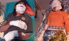 Hai bệnh nhân bị bỏng nặng do thói quen sạc điện thoại qua đêm