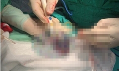 Phẫu thuật cắt một bên tinh hoàn cho nam thanh niêm bị bò đá