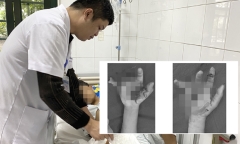 3 thiếu niên bị dập nát bàn tay do chơi pháo tự chơi