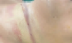 Thanh Hóa: Bị dây thép vắt ngang đường cứa vào cổ khi đang đi xe máy, người đàn ông suýt mất mạng