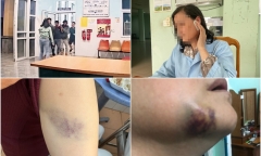 Vụ nữ y sĩ bị 3 người đàn ông đánh hội đồng: Nạn nhân kể lại sự việc gây ám ảnh
