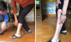 Thanh Hóa: Xác minh nguyên nhân khiến hàng chục người cùng 1 xóm mẩn đỏ toàn thân