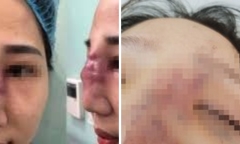 Tiêm filler tại khách sạn, 2 phụ nữ vừa gặp biến chứng vừa bị 