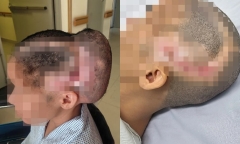 Cứu sống người phụ nữ bị đột quỵ sau khi bơm mỡ tự thân vào vùng thái dương làm đẹp