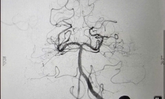 Uống vài cốc bia người đàn ông suýt tử vong vì thể đột quỵ có tỷ lệ chết tới 90%