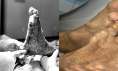 Tự ý dùng thuốc nam trị gout, cụ ông bị biến dạng chân