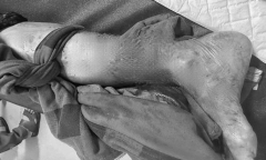 Hà Nội: Một người bị chó nhà cắn gần đứt rời bàn chân