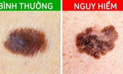 Cẩn thận với nốt ruồi 