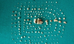 Kinh ngạc bé gái có 202 chiếc răng trong miệng