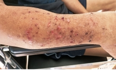 Sau điều trị đột quỵ não, người đàn ông bị ảo giác, tự làm mình bị thương