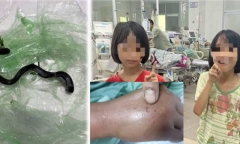 Truyền 10 lọ huyết thanh cấp cứu 2 chị em sinh đôi cùng bị rắn hổ mang tấn công