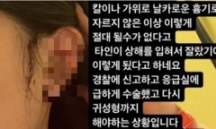 Cô gái hoảng hốt đến viện vì vết thương nghiêm trọng ở tai, chi tiết vụ việc gây bàng hoàng
