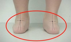 Chân bé trai 4 tuổi bị biến dạng kinh hoàng, tất cả do việc làm thường xuyên này của người bà