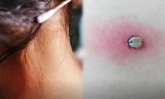 Mẹ giật mình khi phát hiện sự thật về “nốt ruồi” ở gần gáy con gái