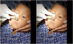 Clip: Sốc nặng trước cảnh bác sĩ gắp đỉa khỏi mũi bé trai