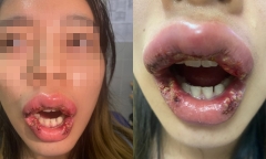 Biến dạng khuôn mặt vì cắt môi trái tim,