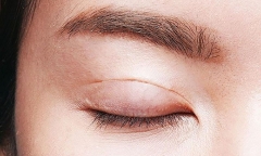 Người bị cận thị có cắt mí được không?