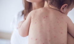 Bộ Y tế: Nhóm tuổi tiêm sởi sẽ do các tỉnh quyết định