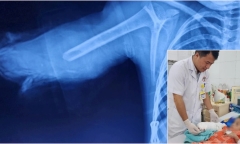 Tay áo khoác cuốn vào bánh xe máy, bé gái 5 tuổi gặp tai nạn thương tâm