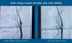 Tin tức đời sống ngày 6/7: Cứu sống người đàn ông bị đột quỵ và nhồi máu cơ tim cùng lúc
