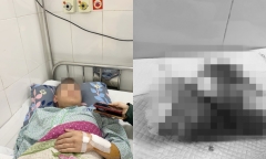 Ký ức kinh hoàng về bữa lẩu sát Tết khiến nam sinh mất đi bàn tay nguyên vẹn