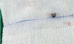 Nghịch súng hơi, bé trai 10 tuổi bị viên đạn chì găm sâu vào xương sọ