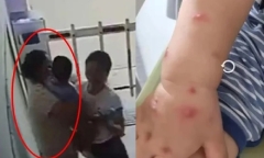 Bé trai 1 tuổi nhiễm bệnh vì nụ hôn của hàng xóm: Lời cảnh tỉnh cho cha mẹ