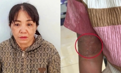 Khởi tố, bắt tạm giam mẹ nuôi tạt nước sôi vào bé gái 12 tuổi vì làm mất vé số