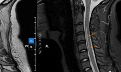 Không chấn thương, nữ sinh đột ngột bị yếu liệt tay vì thói quen nhiều người mắc phải