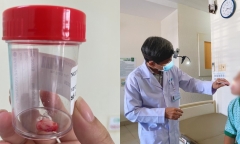 Bệnh nhân có răng mọc lạc chỗ trong xoang sàng được phẫu thuật thành công