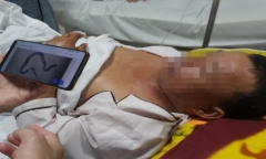 Người đàn ông nhập viện cấp cứu sau khi bị rắn hổ mang cắn