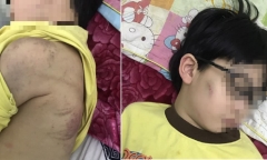 Nghi vấn cháu bé 8 tuổi ở Quảng Ninh bị mẹ đánh nhập viện do....chưa làm bài tập