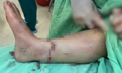 Nữ bệnh nhân được nối liền đoạn chân sau tai nạn giao thông