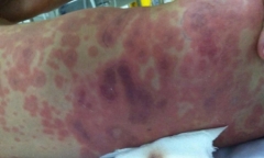 Bé gái 11 tuổi ở Hà Nội mắc viêm não mô cầu, bắt đầu bằng triệu chứng đau đầu, sốt cao