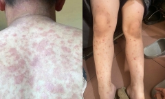 Đi bơi về ngứa rát, nổi mụn mủ: Dấu hiệu cảnh báo bệnh da cần đi khám sớm