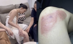 Hé lộ số tiền Ngọc Trinh điều trị sẹo sau tai nạn mô tô