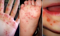 TP.HCM ra văn bản khẩn chỉ đạo phòng chống dịch bệnh tay chân miệng