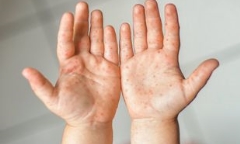Những dấu hiệu khi trẻ mắc tay chân miệng