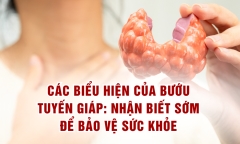 Các biểu hiện của bướu tuyến giáp: Nhận biết sớm để bảo vệ sức khỏe