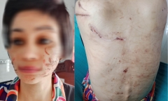 Vụ chồng bạo hành vợ ở Hải Dương: Kinh hãi 205 vết thương chằng chịt trên cơ thể thai phụ