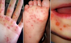 Hà Nội ghi nhận 124 ca tay chân miệng trong một tuần, phát hiện thêm ổ dịch mới