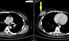 Từ chối điều trị ung thư, tự uống thuốc nam khiến bệnh di căn, chuyển nặng