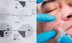 Tiêm filler vào vùng trán lõm, nam thanh niên 23 tuổi có nguy cơ mù lòa