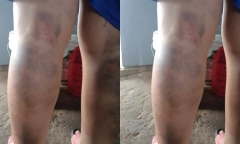  Làm rõ vụ nam sinh lớp 6 ở Quảng Nam bị cô giáo đánh bầm tím 2 chân