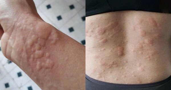 Sau bữa tiệc tất niên, người đàn ông Hà Nội nhập viện vì dị ...