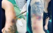 Bi hài hậu vận thẩm mỹ: Tiêm botox thon gọn bắp tay tại cơ sở Spa, cô gái nhận cái kết đắng