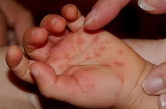 Biện pháp phòng chống bệnh chân tay miệng