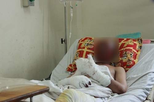 Nổ lò nung, 2 công nhân bị bỏng nặng