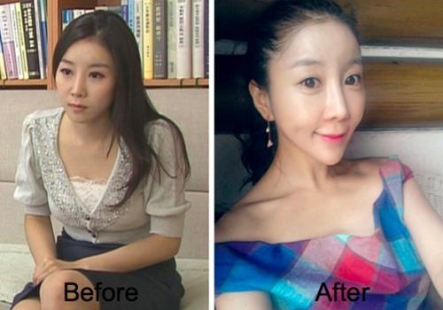 Sốc với gương mặt biến dạng của người mẫu 15 tuổi sau phẫu thuật thẩm mỹ